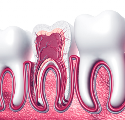 Root Canal Treatment - Cygnet House Dental