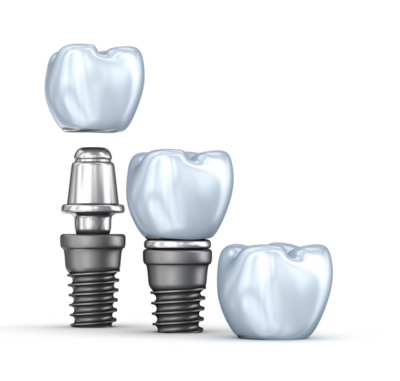 Single Tooth Dental Implant - Cygnet House Dental